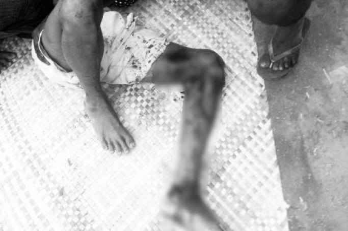 ပုံအညွှန်း - စစ်ကောင်စီ​၏ လက်နက်ကြီးကြောင့် ဒဏ်ရာရ အရပ်သားတဦး (ဓါတ်ပုံ- Crd)